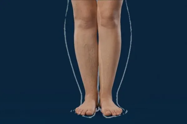 benefits of normatec boots for leg swelling
